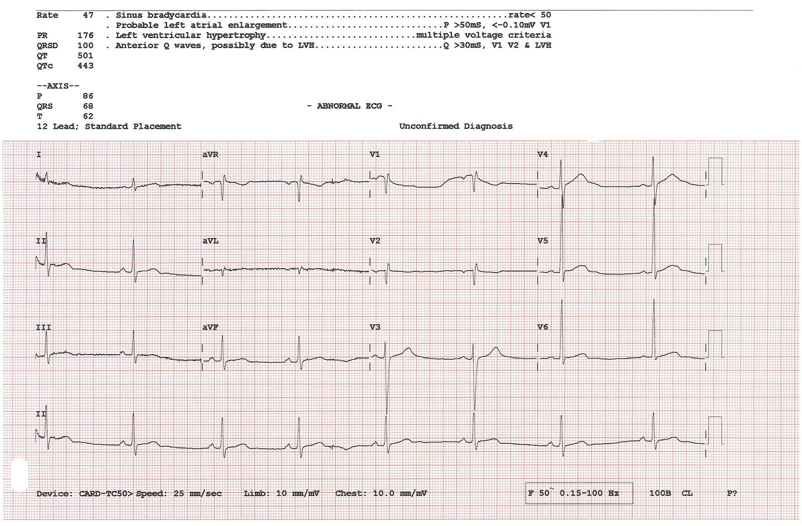 EKG STEMI
